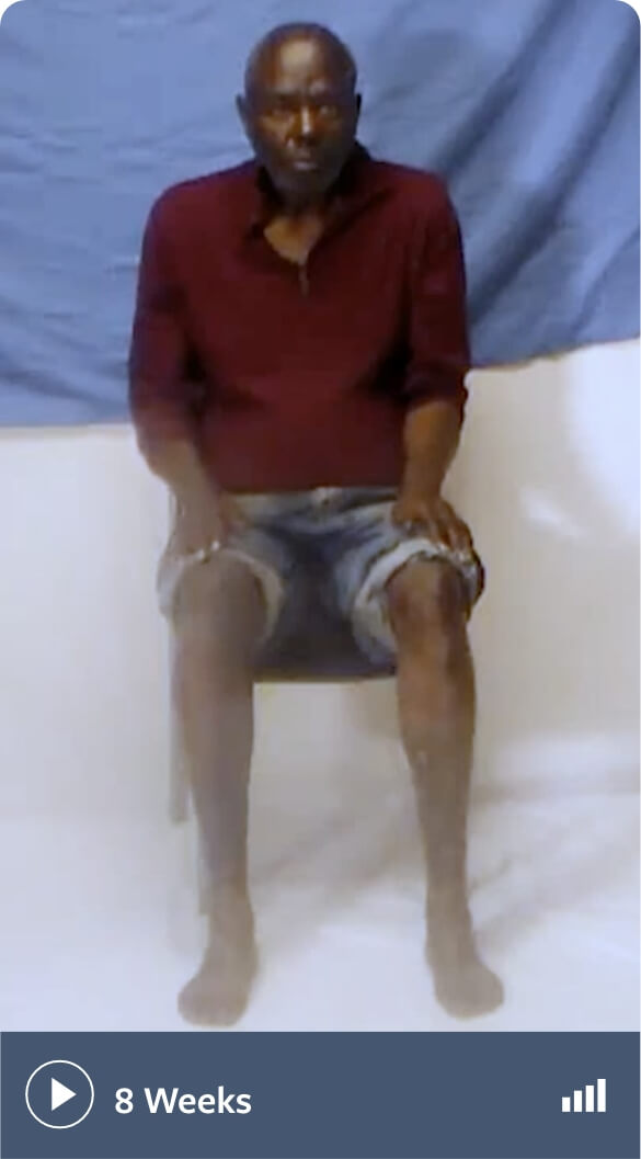 TD Patient Videos | INGREZZA® (valbenazine) capsules | HCP