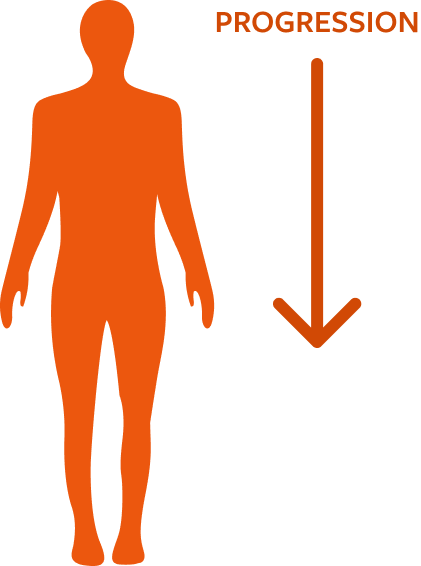 HD chorea starts small and progresses to larger movements